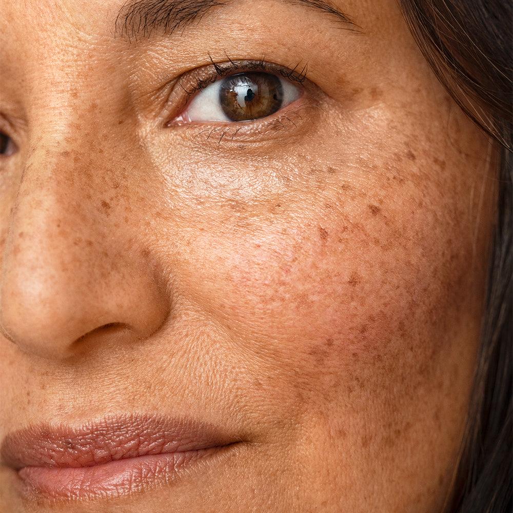 Pigmentation & Sun Damage