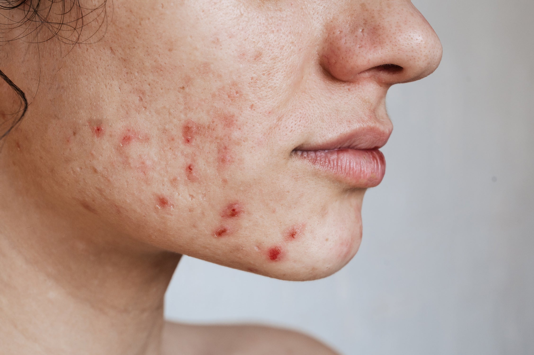 Acne & Congestion